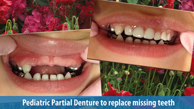 Pediatric Dental Before and Afters | Dr. Levi Palmer's Pediatric