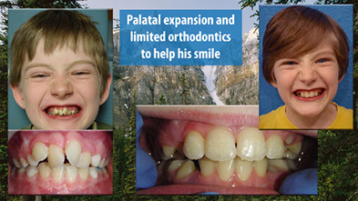 Pediatric Dental Before and Afters | Dr. Levi Palmer's Pediatric