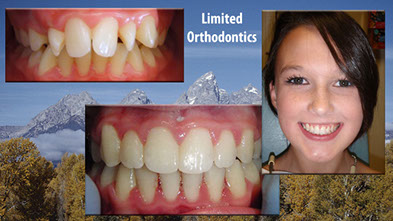 Pediatric Dental Before and Afters | Dr. Levi Palmer's Pediatric Dentistry  in Chico California