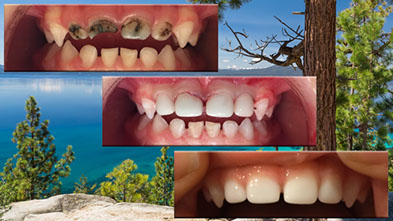 Pediatric Dental Before and Afters | Dr. Levi Palmer's Pediatric Dentistry  in Chico California